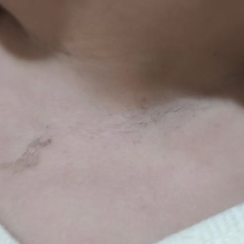 1 Yaşındaki Çocuğumun Anestezi Ve Tomografi Sürecinde İhmal Ve Kötü Muamele
