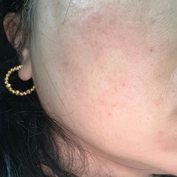 Pharmaceris Nemlendiricisi Nedeniyle Ciltte Kaşıntı Ve Kızarıklık, İade Talebi