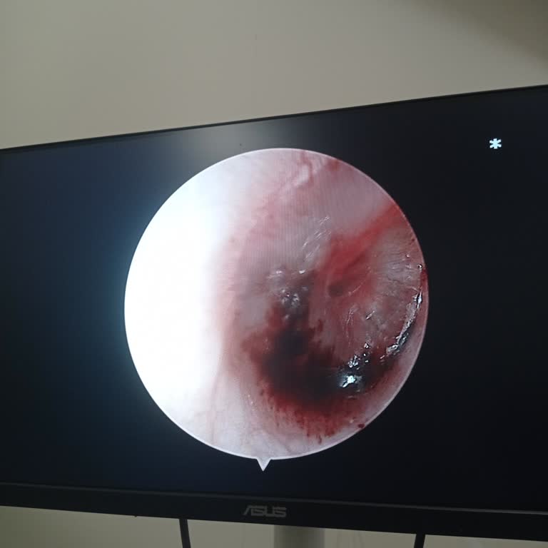 Kulak Zarının Patlaması Hakkında Yanlış Bilgilendirme Ve Gereksiz İşitme Testi Ücret İadesi Talebi