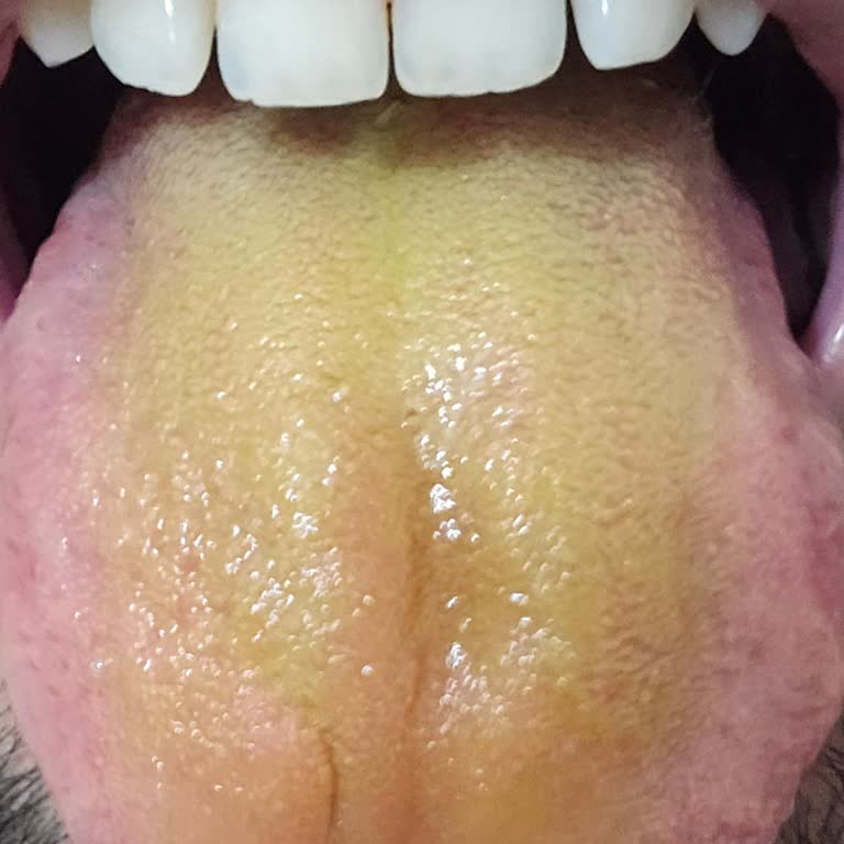 Ülker Pastil Ürünün Aşırı Acı Tatı Ve Boğaz Yanması