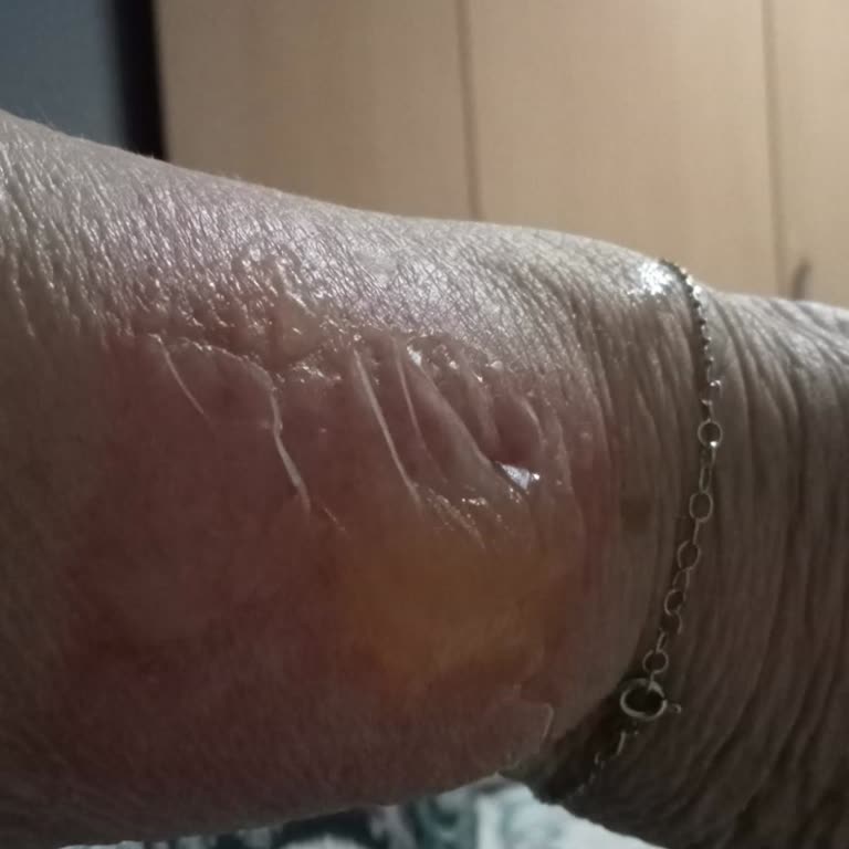 Benri El Ayak Isıtıcıda Kısa Sürede Yanık Ve Su Toplanması, Güvenlik Sorunu