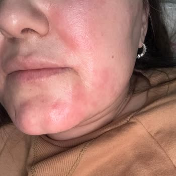 Yves Rocher Pure Algue Yüz Yıkama Jelinde Şiddetli Yanma Ve Cilt Tahrişi