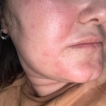 Yves Rocher Pure Algue Yüz Yıkama Jelinde Şiddetli Yanma Ve Cilt Tahrişi