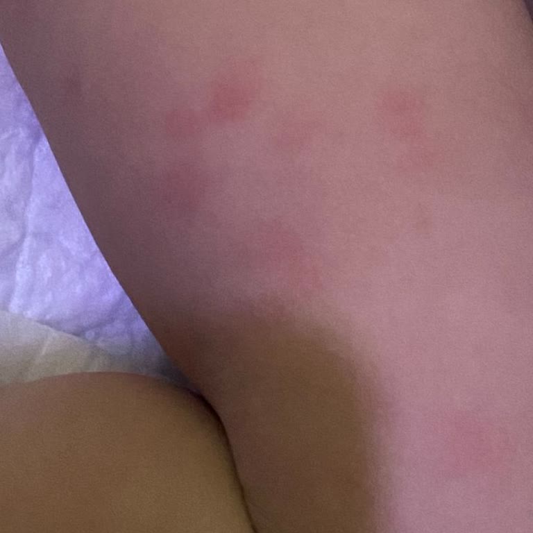 Pofy 6 Numaralı Bebek Bezinde Şiddetli Alerjik Reaksiyon Ve Kötü Koku