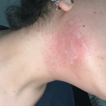 Şok Marketten Alınan Ten Hazır Sir Ağda Bandı Sonrası Şiddetli Yanma Ve Yanık Şikayeti