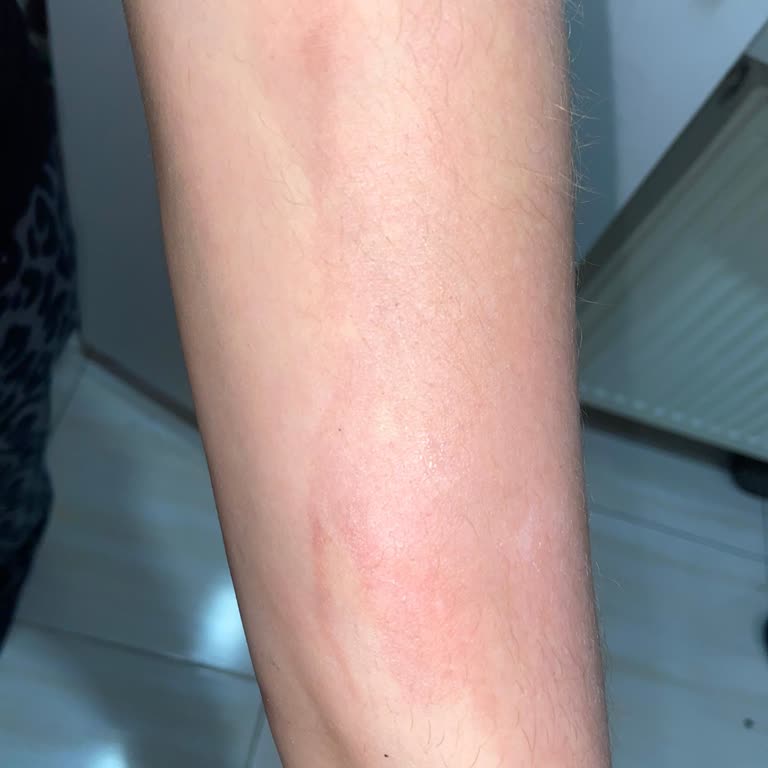 Sesu Tüy Sarartıcı Krem Kullanımında Cilt Yanıkları Ve Şiddetli Reaksiyonlar