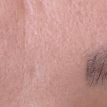 Microblading Yanıltıcı Sözler, Kalıcı İzler Ve Beklentileri Karşılamayan Sonuç