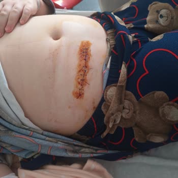 Vega Hospital’da Yanlış Tanı Sonucu Çocuğumun Apendisit Patlaması Ve Uzun Hastanede Kalma Süreci