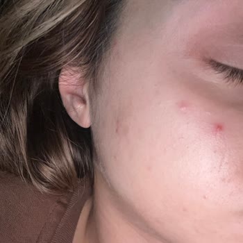 Sebo Active Krem Kullanımından Şiddetli Sivilce Ve İade Talebi