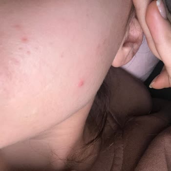 Sebo Active Krem Kullanımından Şiddetli Sivilce Ve İade Talebi