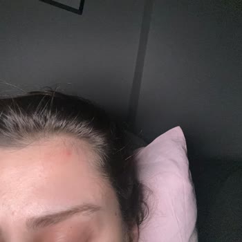 Sebo Active Krem Kullanımından Şiddetli Sivilce Ve İade Talebi