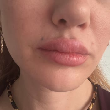 Esteville Estetik Başarısız Dudak Dolgusu İşlemi!