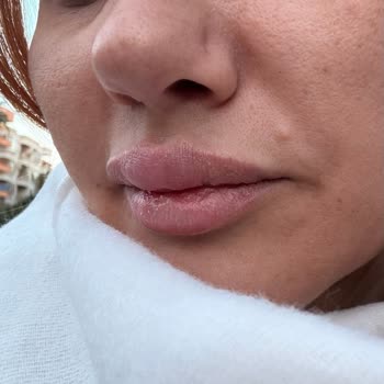 Esteville Estetik Başarısız Dudak Dolgusu İşlemi!