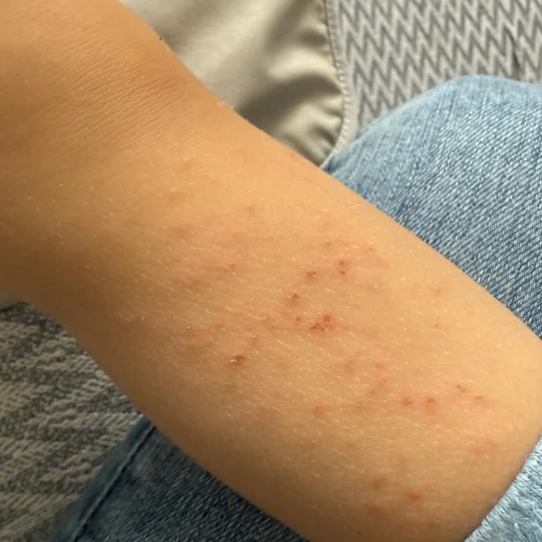 İncia Mosquito And Tick Spreyinin Yanlış Kullanımından Kaynaklanan Şiddetli Alerjik Reaksiyon