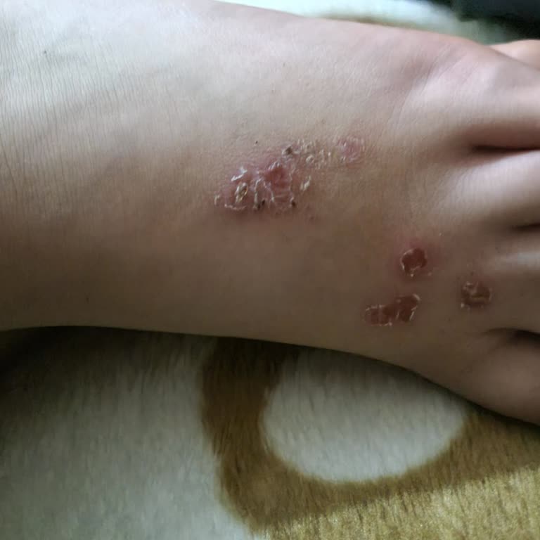 Lumberjack Botunda Alerjik Reaksiyon Ve Mağazanın İlgisiz İade Süreci