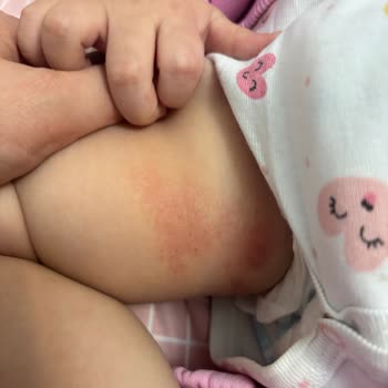 Pofy Bebek Bezinin Şiddetli Yanık Benzeri Cilt Yaraları Oluşturması