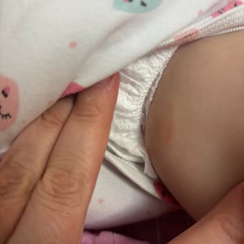 Pofy Bebek Bezinin Şiddetli Yanık Benzeri Cilt Yaraları Oluşturması