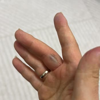 Philips Süpürge Borusu İçeri Kaçıyor Ve Parmağımı Sıkıştırıyor, Değişim Talebi