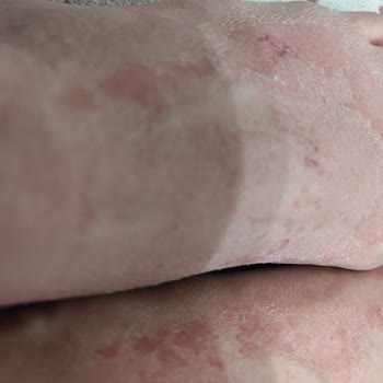 Dermokil Ayak Maskesi Kullanımından Sonra Şiddetli Kızarıklık Ve Kaşıntı, Şirketin Yetersiz Cevabı