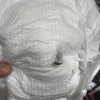 Molfix Bebek Bezinde Siyah Leke Ve Toz Birikintisi: Sağlık Endişesi