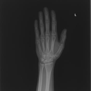 Acil Serviste Görülmeyen Tendon Kırığı Sonrası Ameliyat Ve Özür Talebi