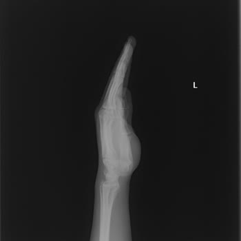 Acil Serviste Görülmeyen Tendon Kırığı Sonrası Ameliyat Ve Özür Talebi