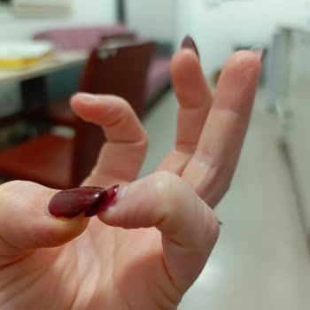 Hatalı Uygulama Sonrası Tırnak Düşmesi Ve Hijyen Sorunu