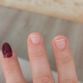 Hatalı Uygulama Sonrası Tırnak Düşmesi Ve Hijyen Sorunu