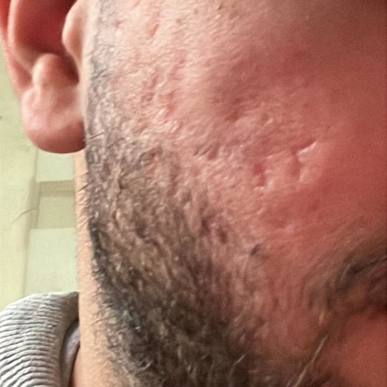 Söz Verilen Lazer Tedavisi Sonuç Vermedi, Yüzümde Kalıcı Kızarıklık Bıraktı