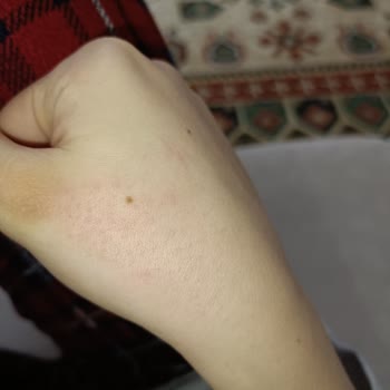 Watsons Frudia Ürünleri Kullanımından Sonra Ciltte Şiddetli Kaşıntı Ve Kızarıklık