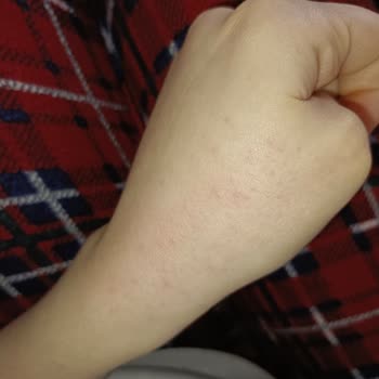 Watsons Frudia Ürünleri Kullanımından Sonra Ciltte Şiddetli Kaşıntı Ve Kızarıklık