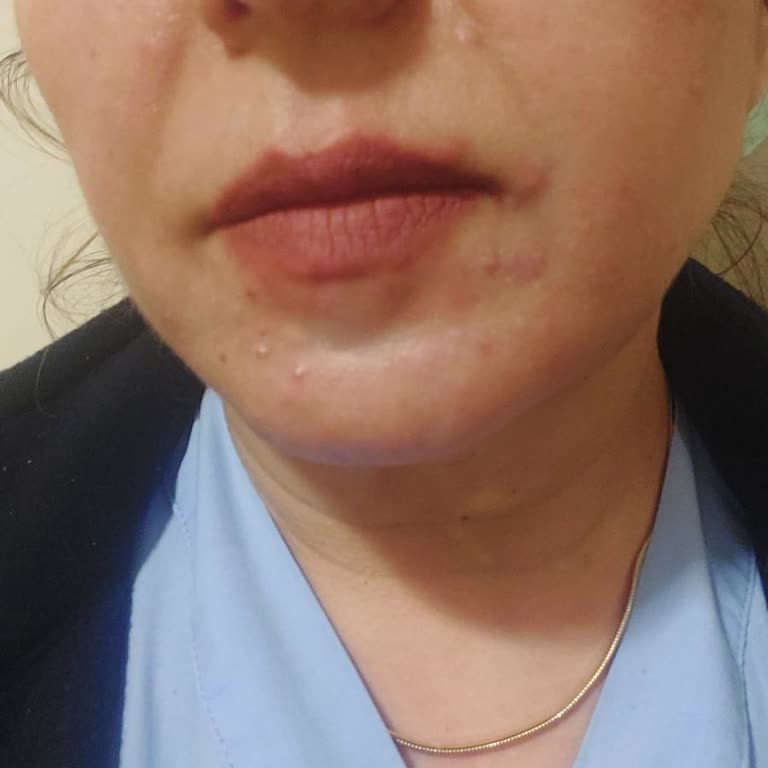 Lancome Sağlık Sorunlarına Neden Olan Cilt Bakım Ürünleri İçin Koşulsuz İade Talebi