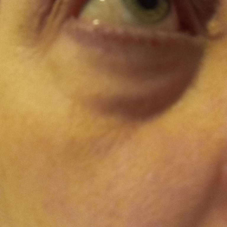 Isana Gözaltı Pedinde Şiddetli Şişlik ve Torbalı Reaksiyon, İade Talebi