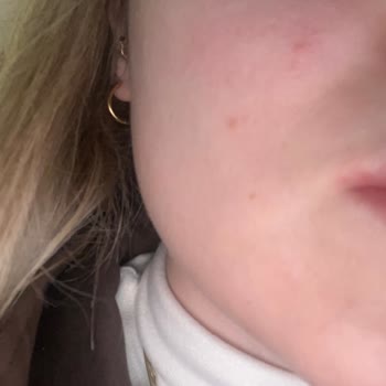 Solgar Biotin Takviyesi Şiddetli Sivilcelenmeye Neden Oldu