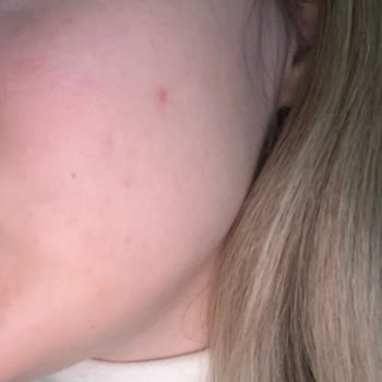 Solgar Biotin Takviyesi Şiddetli Sivilcelenmeye Neden Oldu