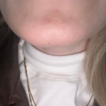 Solgar Biotin Takviyesi Şiddetli Sivilcelenmeye Neden Oldu