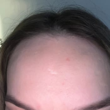 Solgar Biotin Takviyesi Şiddetli Sivilcelenmeye Neden Oldu