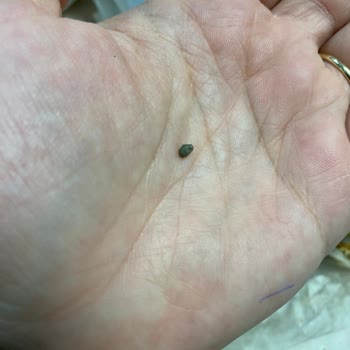 Burgerde Taş Nedeniyle Diş Kırıldı, Sağlık Riski Ve Cevapsız Müşteri Hizmetleri