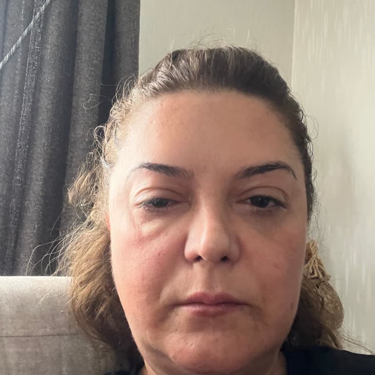 Botoks Sonrası Göz Kapağı Düşmesi Ve Görme Problemleri