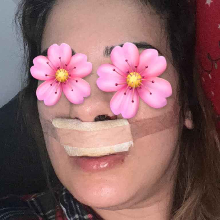 Op. Dr. Onur Tüylü Başarısız Septum Ameliyatı Sonrası Yıllarca Süren Nefes Sıkıntısı