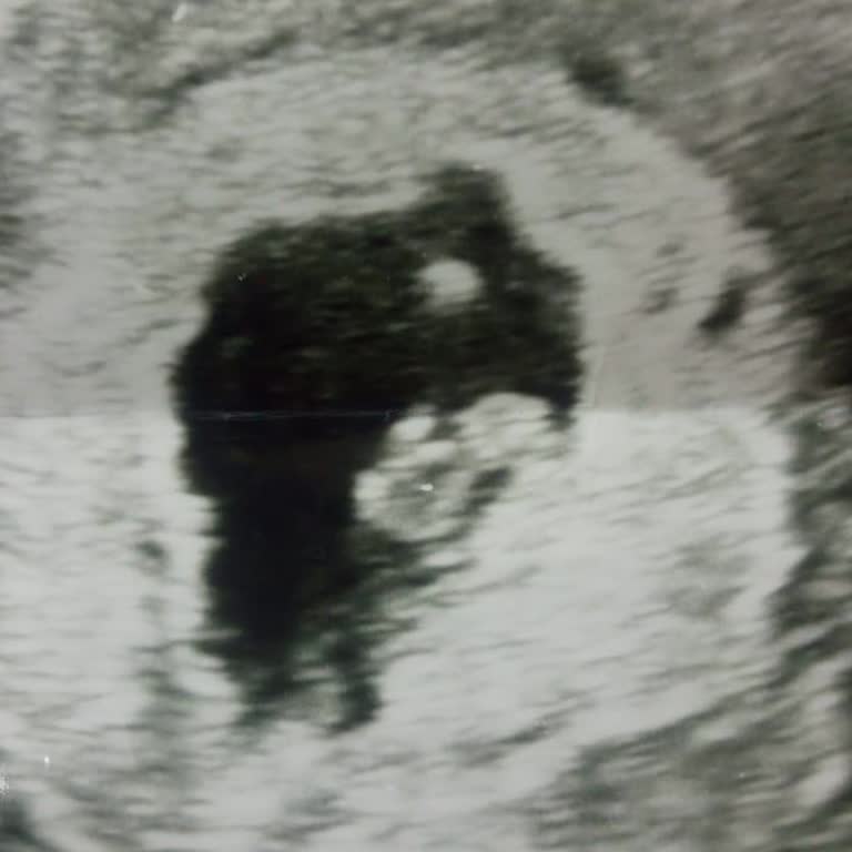 Bursa Yüksek İhtisas Kadın Doğumda Yanıltıcı Tanı Ve Saygısız Davranış