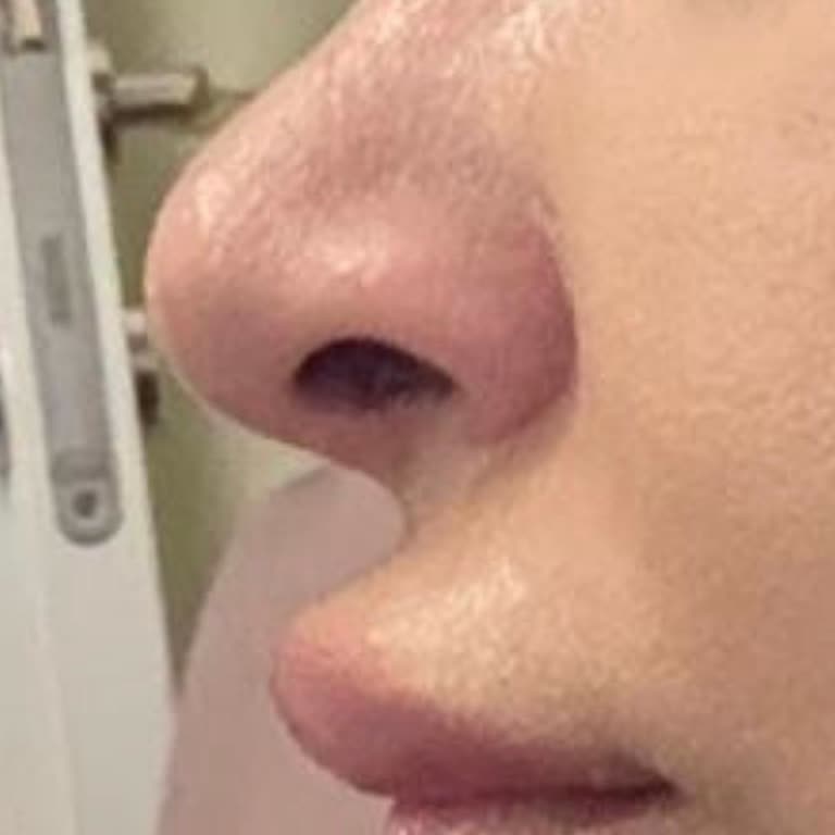 Bakırköy İlya Clinic Personelinin Doktor Olmadığı Ve Dudak Dolgusu Sonucunda Yaşanan Estetik Kaza