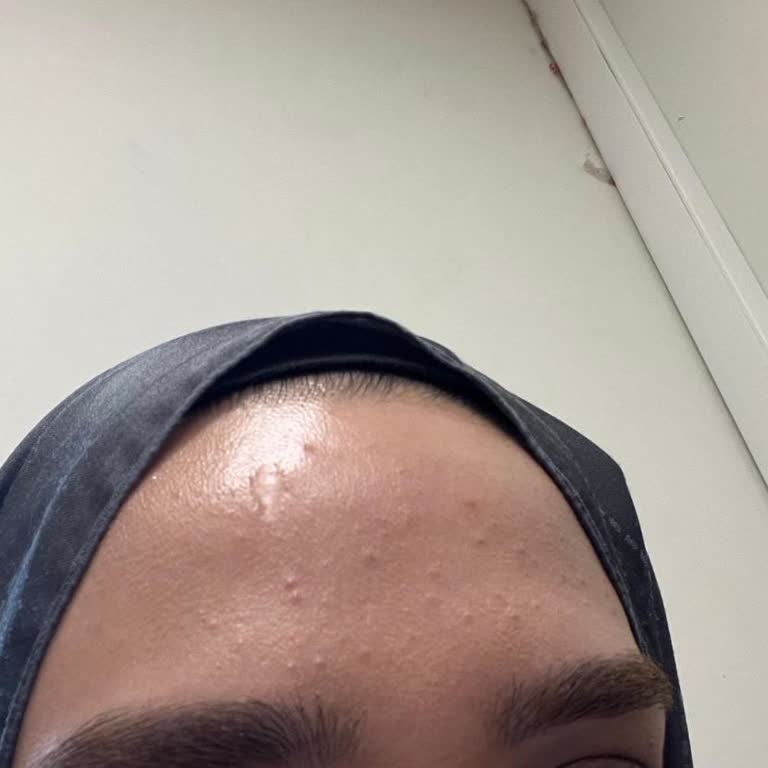 Isabel Zey Beauty Rızam Olmadan Pico Cihazıyla İşlem Yapılmıştır