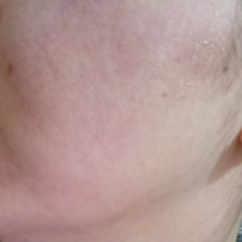 Yüz Yıkama Jelinde Kızarıklık Ve Yanma Nedeniyle Ücret İadesi Talebi