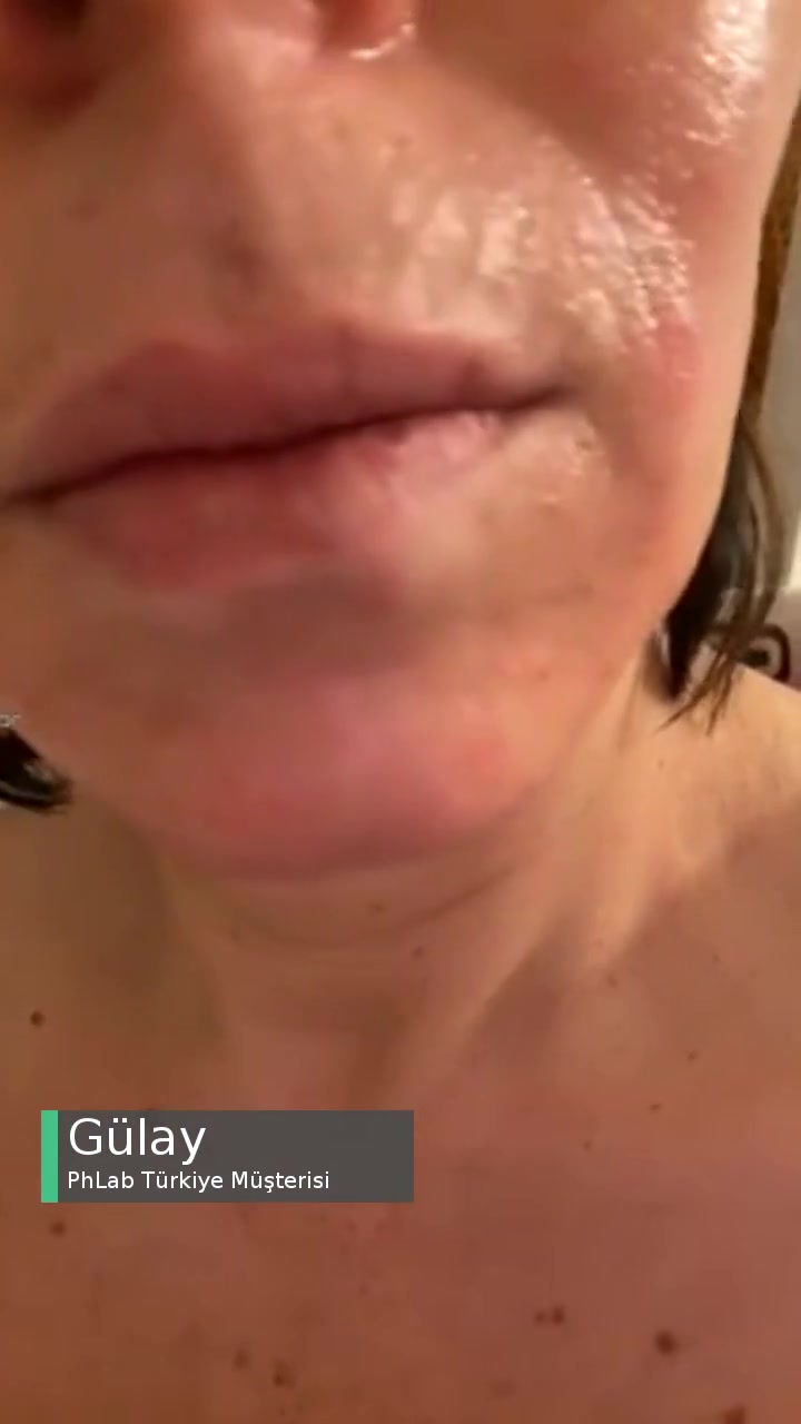 Phlab Türkiye Kızarıklık Ve Kuruluk videonun kapak resmi