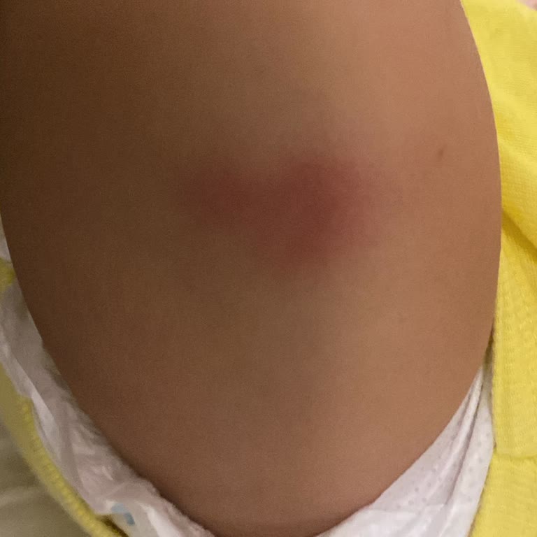 Hemşirenin Dikkatsizliği Ve Yanlış E-Nabız Kaydı Nedeniyle Bebeğimin Aşı Sonrası Şiddetli Şişliği