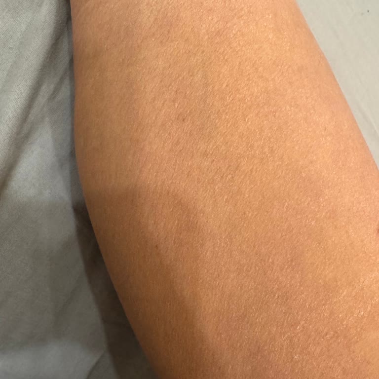 Lazer Epilasyon Sonrası Şiddetli Cilt Kuruluğu Ve Yetersiz Çözüm Önerisi