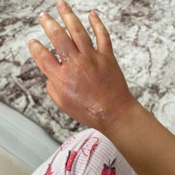 Emsan Çaydanlıkta Kapak Çıktı: El Yanması ve Güvenlik Sorunu