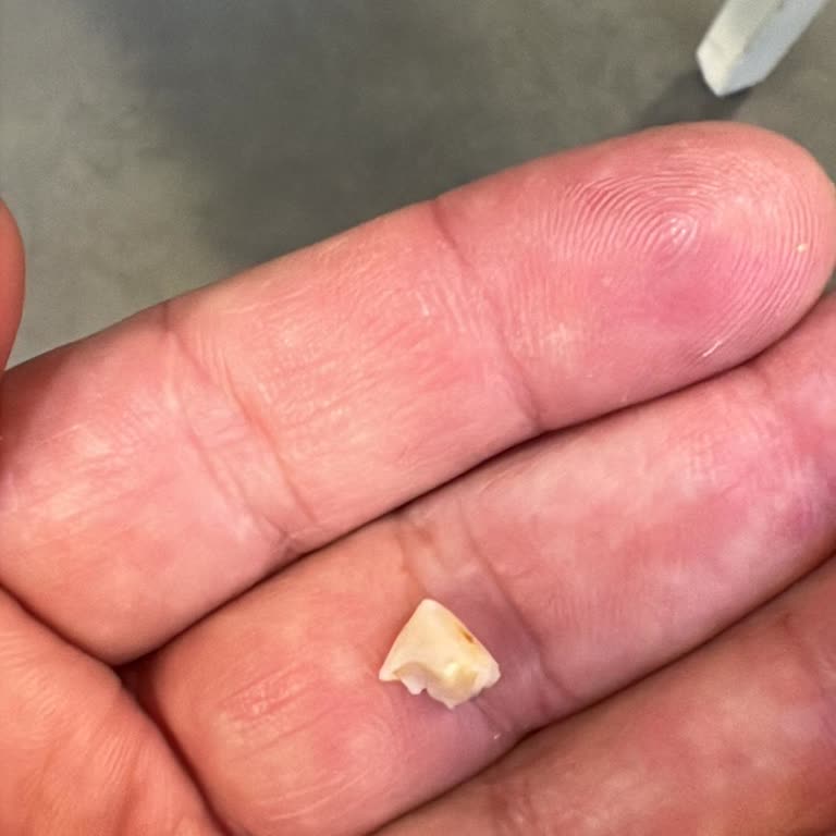 Beyaz Sandal Balıkçısı | Gebze Kalitesiz Bir Çatal Nedeniyle Dişim Kırıldı ve Dişimi Kaybettim