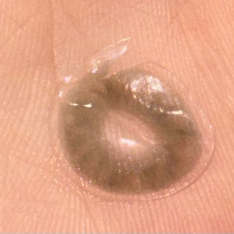 Üç Gün İçinde Lensin Deforme Olması Ve İade Talebi